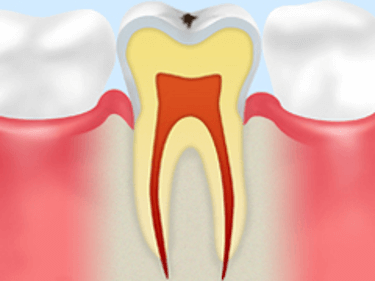 【C0】ごく初期の虫歯