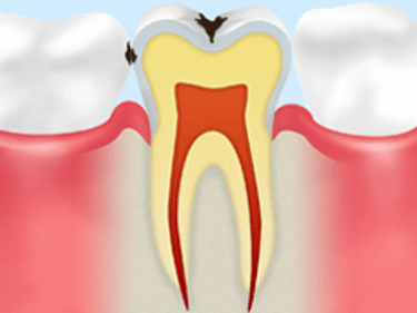 【C1】エナメル質の虫歯