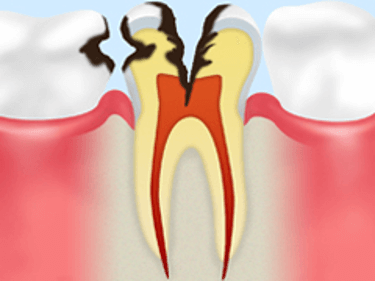 【C2】象牙質の虫歯