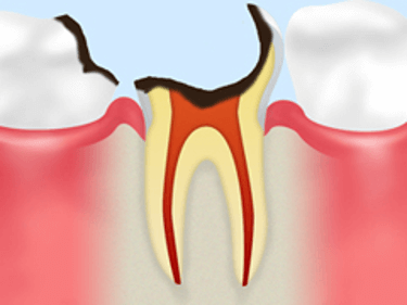 【C3】神経に達した虫歯