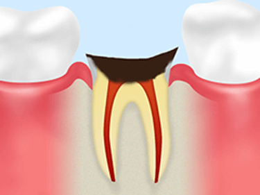 【C4】歯根に達した虫歯