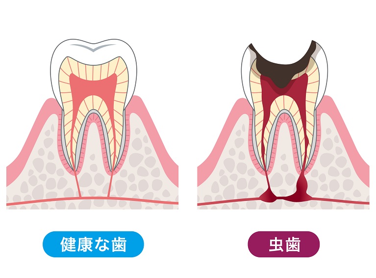 虫歯とは