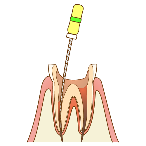 根管治療