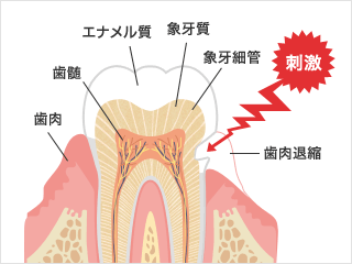 知覚過敏